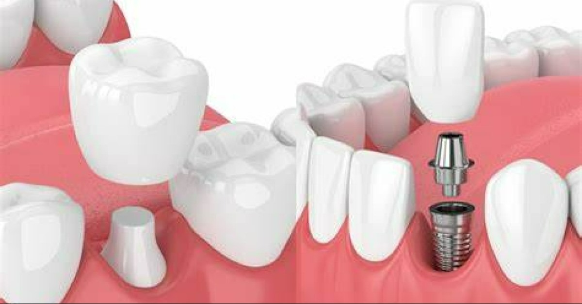 Dental Implants vs Crowns - Which Is Right for You?